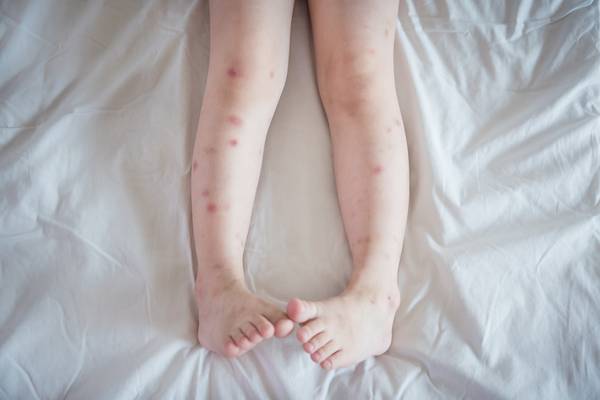 Mosquito bite feet in bed